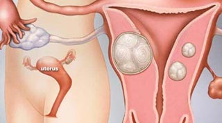 Nguyên nhân và triệu chứng u xơ tử cung