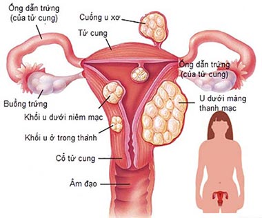 Những điều cần biết về bệnh u xơ tử cung